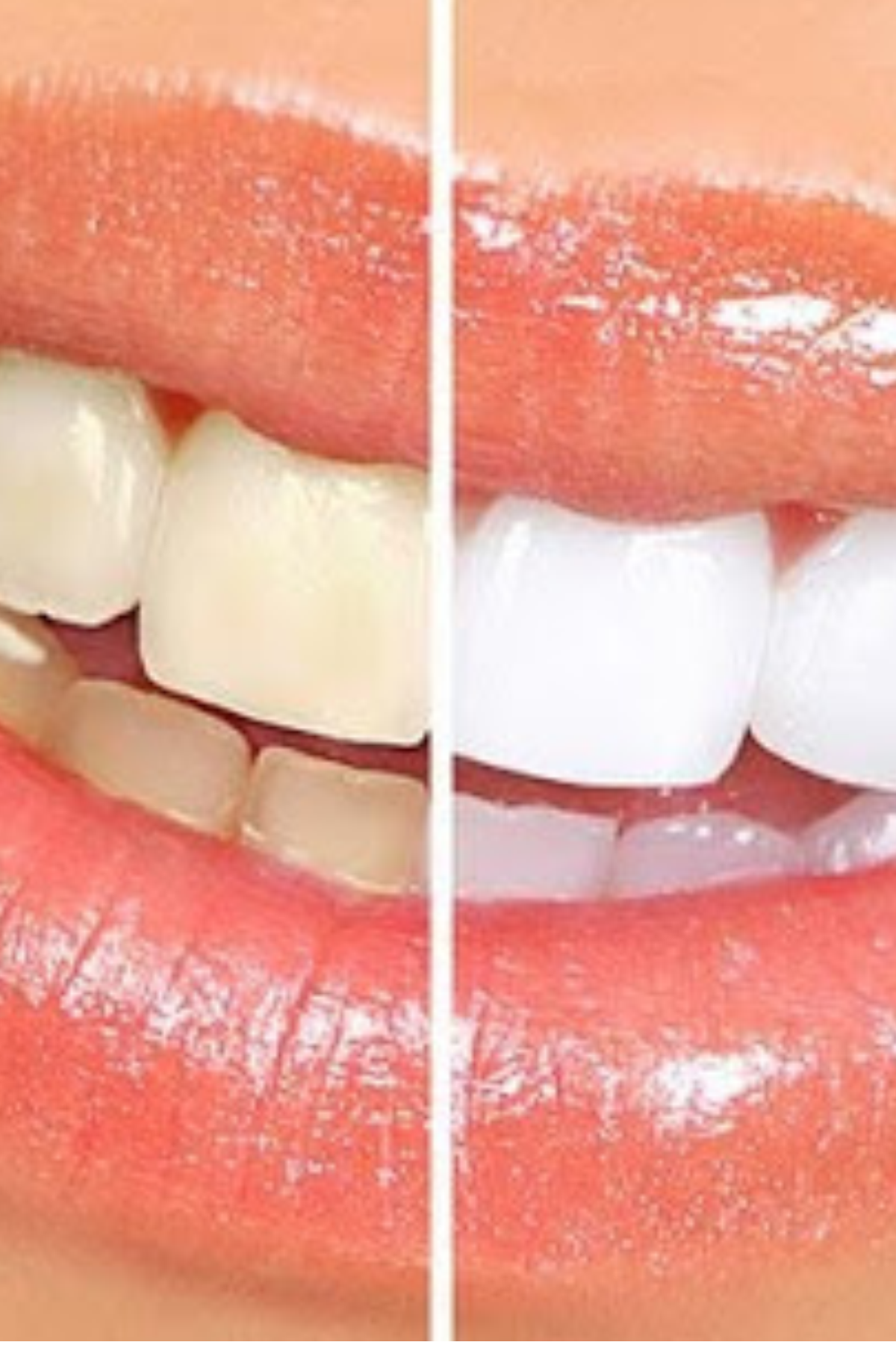 Antes e depois do clareamento dental