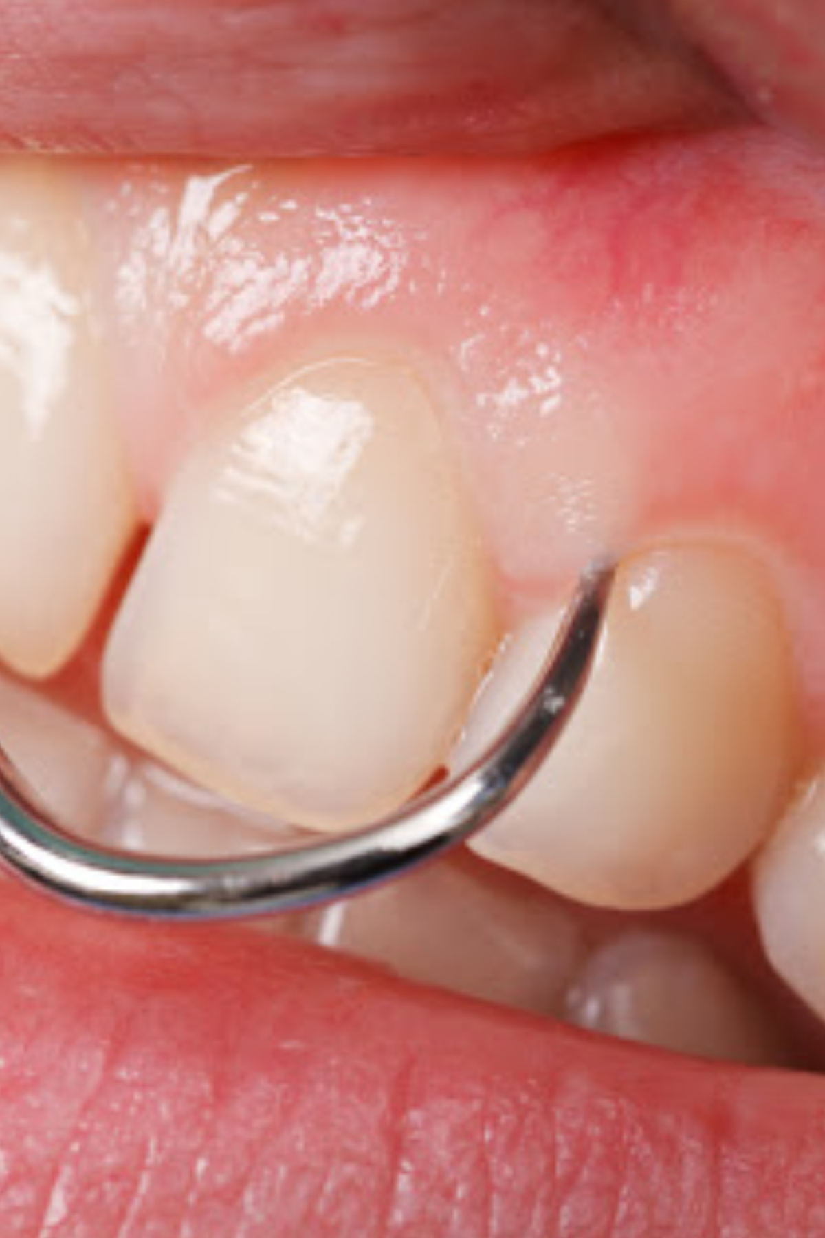 Tratamento periodontal na gengiva